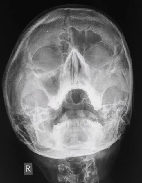 Waters view X-ray of paranasal sinuses