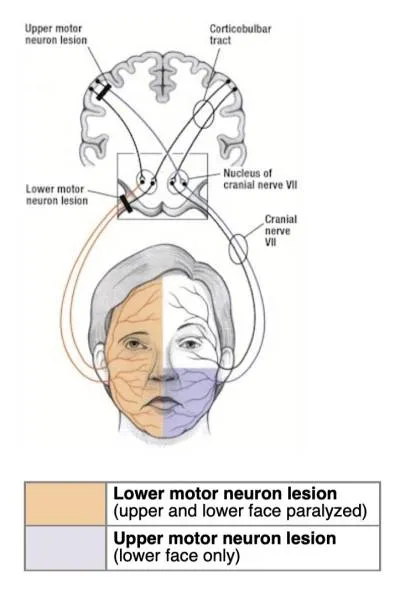 Facial Paralysis: UMN vs. LMN Lesions