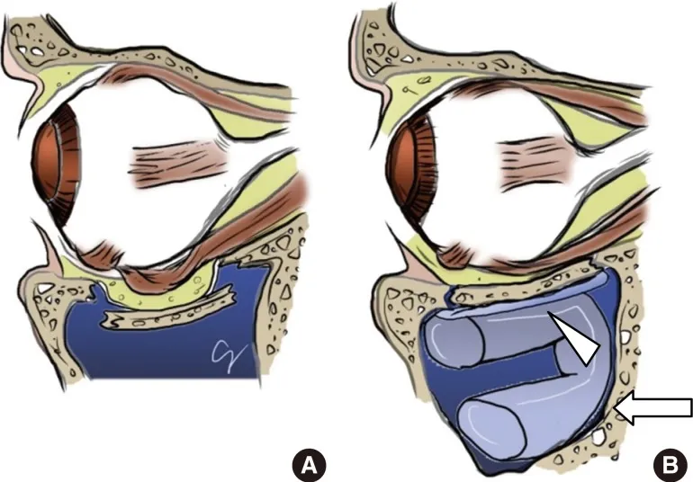 Orbital floor fracture with muscle entrapment diagram