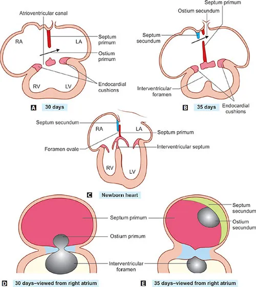 Atrial Septation: Ostium Primum, Secundum, Foramen Ovale