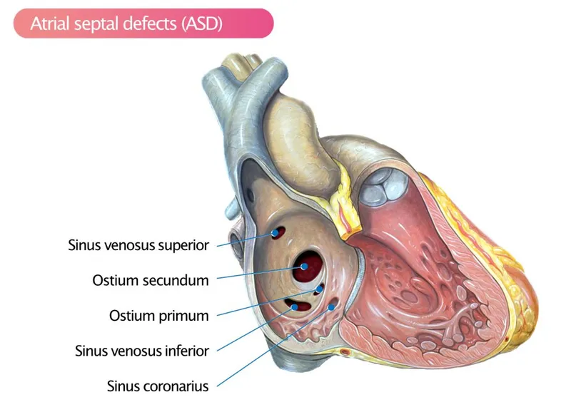 Atrial Septal Defects (ASD) Types
