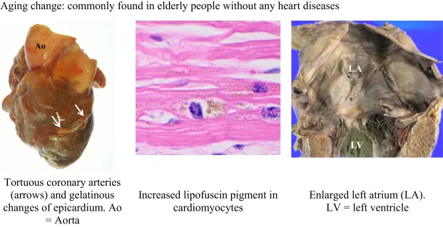 Lipofuscin pigment in aging cardiomyocytes