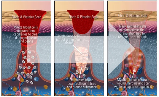 Wound Healing: Granulation Tissue Formation and Remodeling