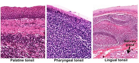 Histology of palatine, pharyngeal, and lingual tonsils