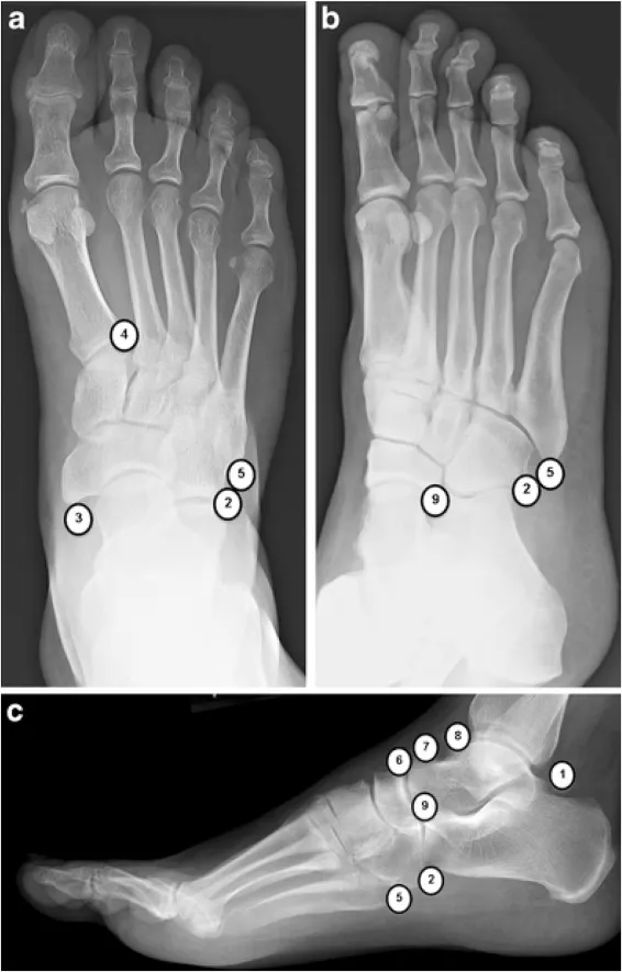 Foot X-rays: Accessory ossicles and anatomical variants