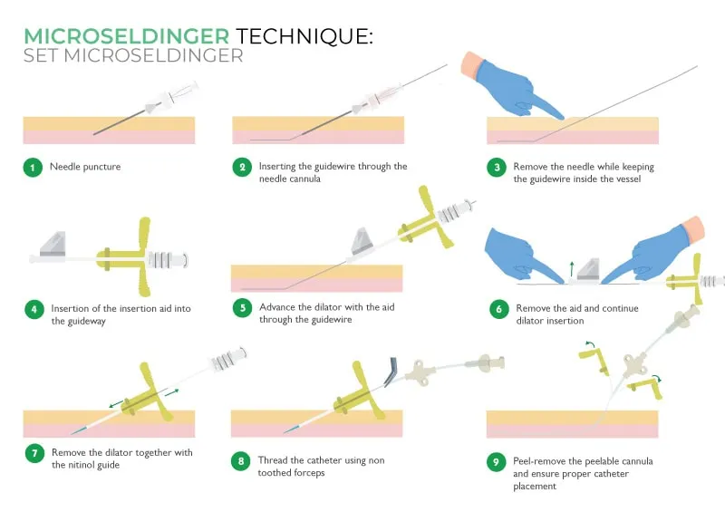 Microseldinger Technique Steps