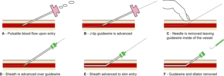 Seldinger technique for arterial access