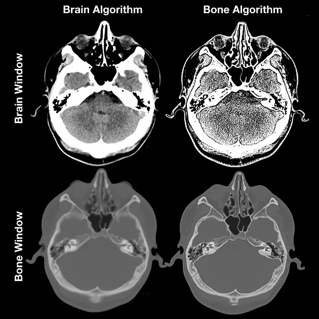 CT head scan: Brain and bone windowing comparison