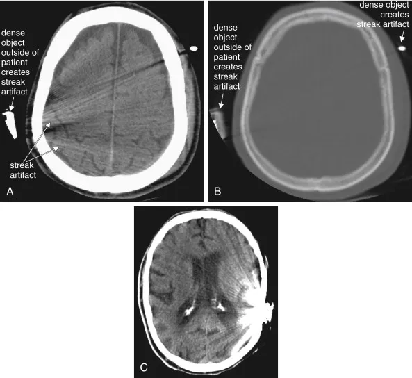 CT Scan Artifacts: Motion, Beam Hardening, Metallic Streak