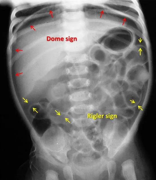 Abdominal X-ray: Rigler's sign in pneumoperitoneum