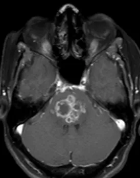 MRI Brain: Ring-enhancing lesion with gadolinium contrast