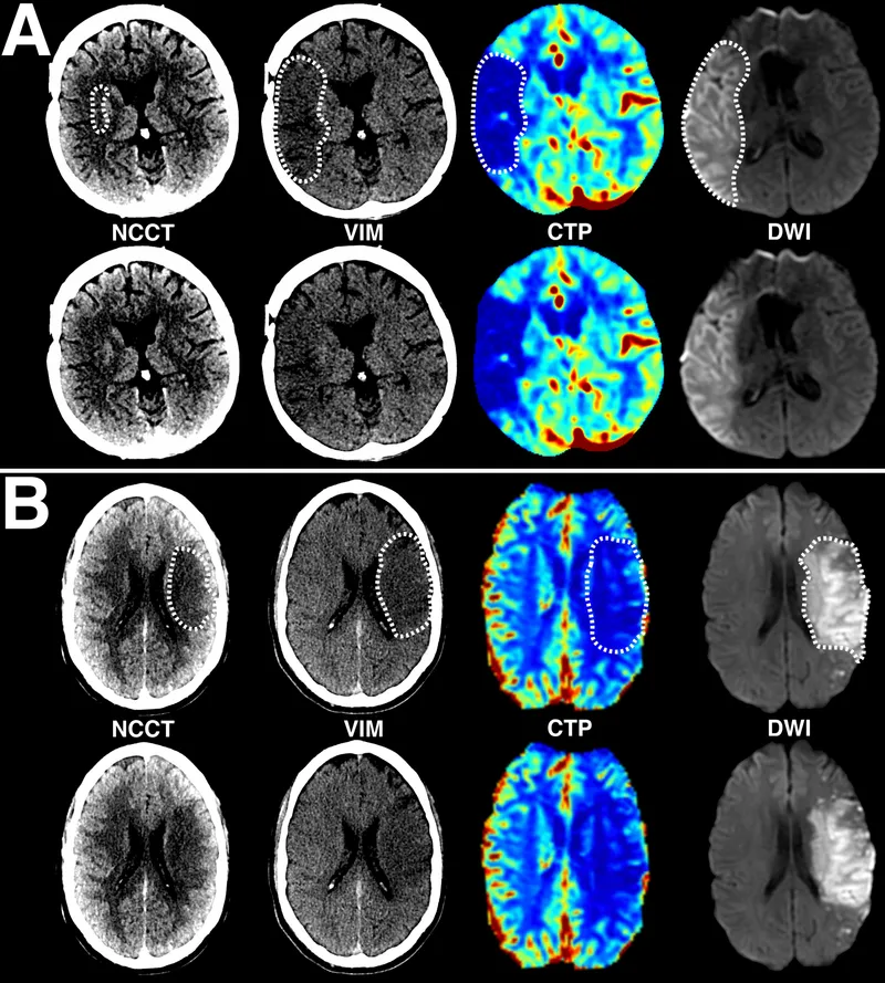 Ischemic vs. Hemorrhagic Stroke on CT and Perfusion