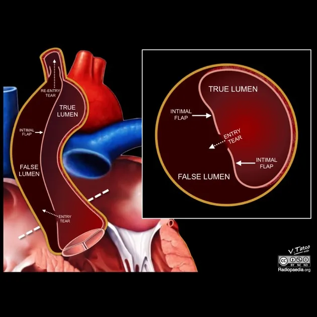 Aortic dissection: true and false lumens, intimal flap