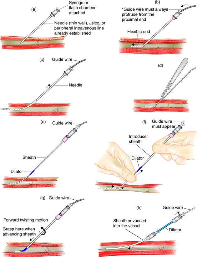 Seldinger Technique Steps
