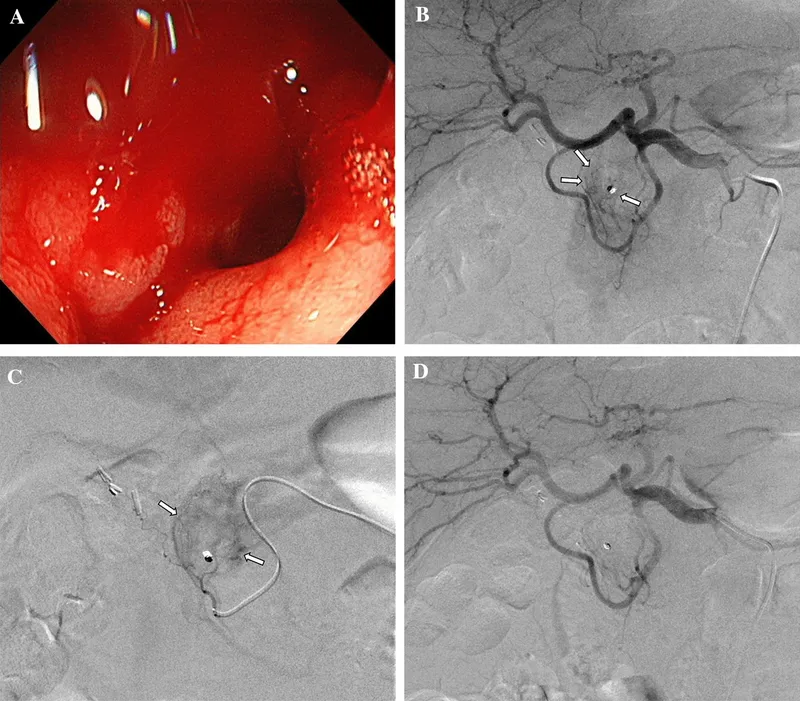Angiogram: Coil embolization of bleeding visceral artery