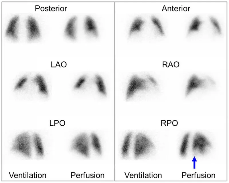 V/Q scan showing mismatched defect in pulmonary embolism