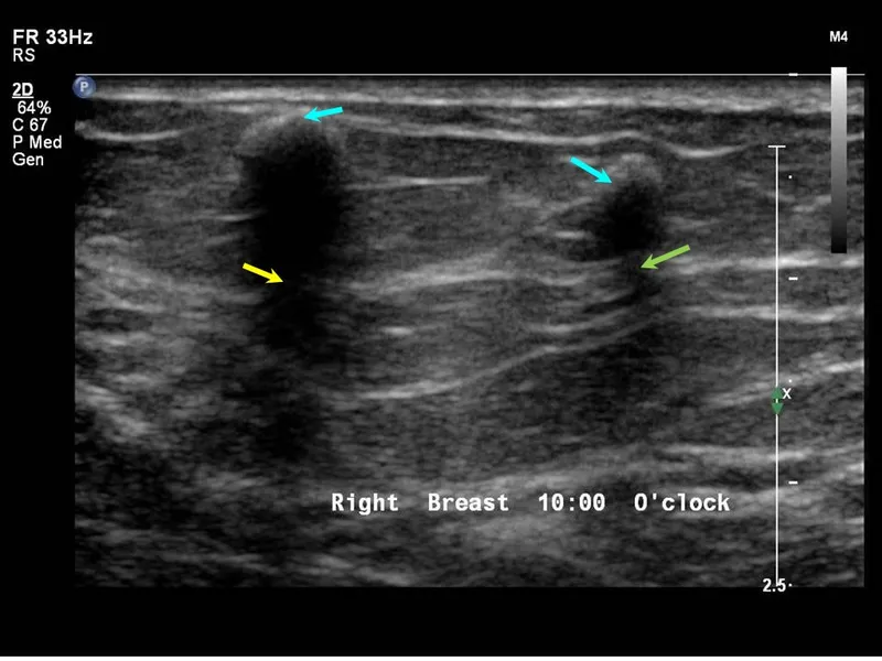 Ultrasound: Echogenicity, shadowing, and enhancement