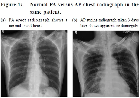 PA vs. AP Chest X-ray: Cardiac Magnification