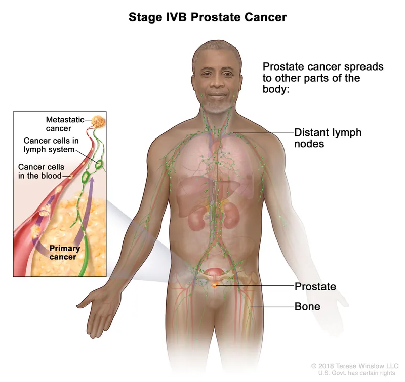 Prostate cancer spread via lymphatic system and blood
