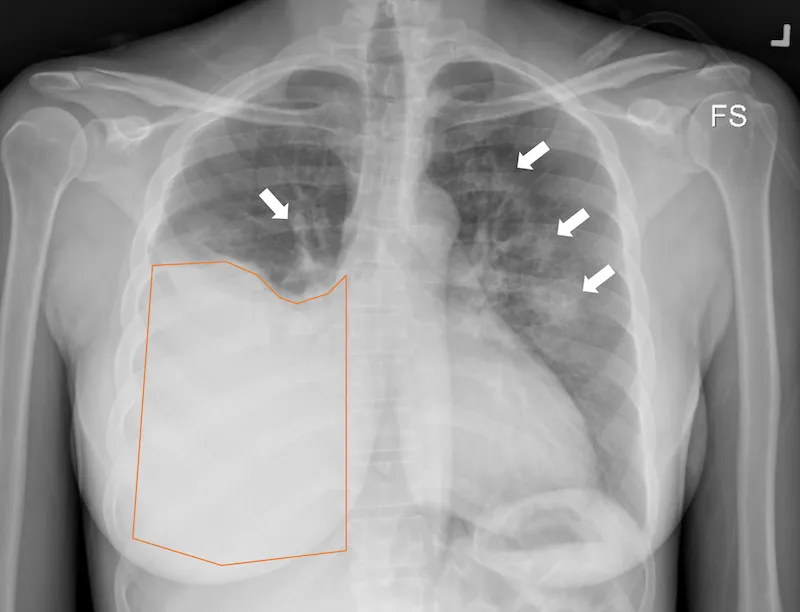 Chest X-ray: Chylothorax with Pleural Effusion