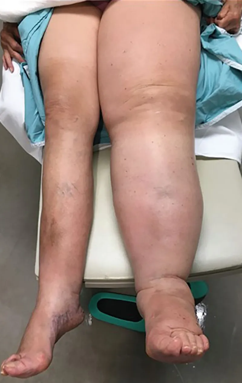 Lymphedema of lower limbs