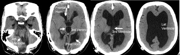 CT scan of hydrocephalus with dilated ventricles