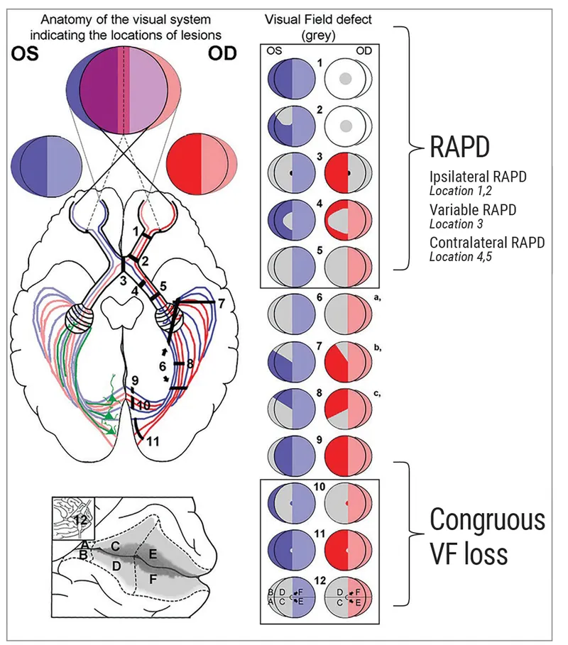 Visual Pathway Lesions & Field Defects