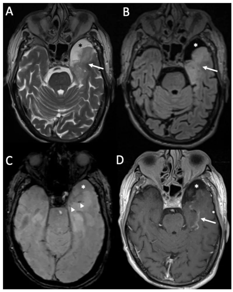 MRI: HSV-1 Encephalitis with Temporal Lobe Hyperintensity