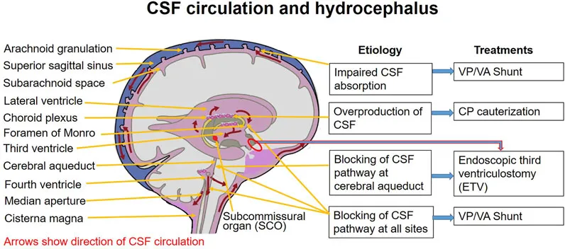 CSF circulation and hydrocephalus etiology and treatments