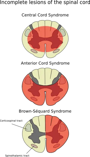 Spinal Cord Syndromes: Brown-Séquard, Anterior, Central