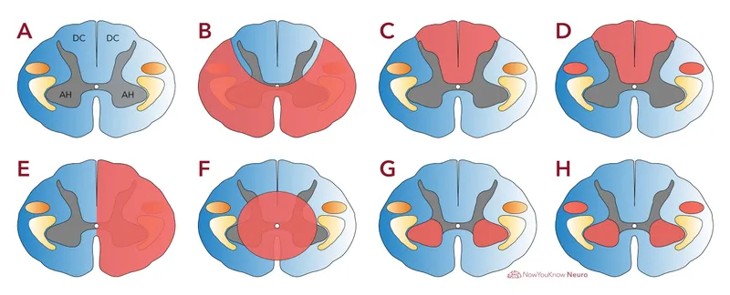 Spinal Cord Lesions: Brown-Séquard, Tabes, Syringomyelia