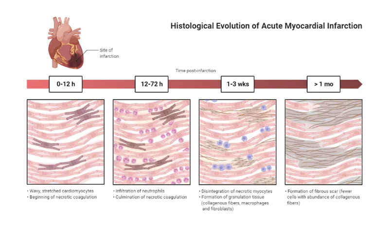 Histological Evolution of Acute Myocardial Infarction