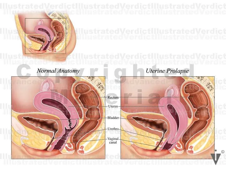 Female Pelvis: Normal vs. Uterine Prolapse