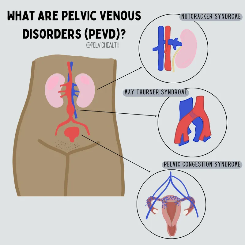 Pelvic Venous Disorders: Nutcracker, May-Thurner, Congestion