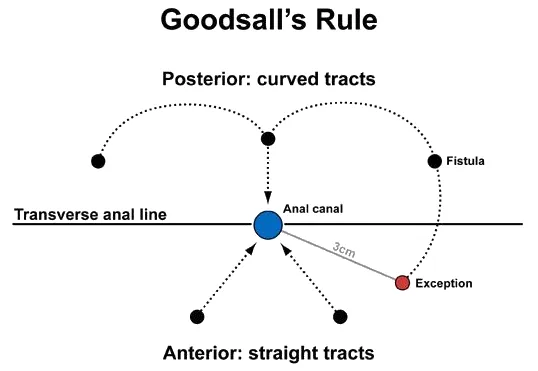 Goodsall's Rule for Anorectal Fistulas