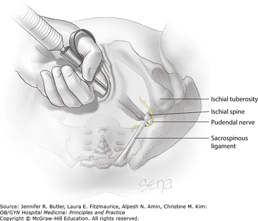 Pudendal nerve block landmark ischial spine
