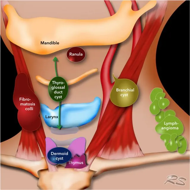 Neck cysts and masses