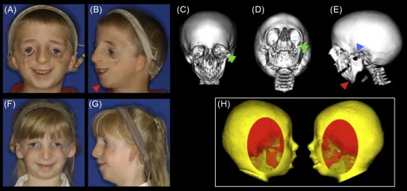 Treacher Collins vs. DiGeorge syndrome facial features