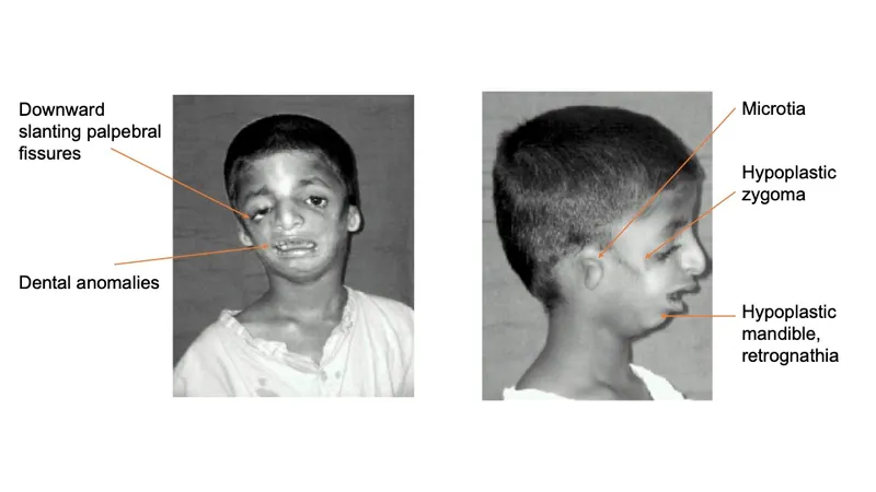 Treacher Collins syndrome craniofacial abnormalities