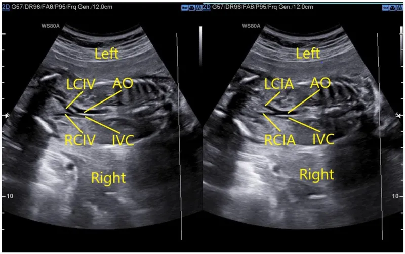 Abdominal ultrasound with major vessel labels