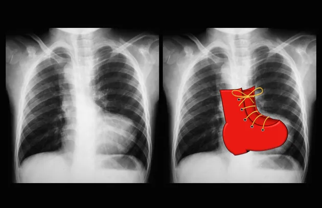 Boot-shaped heart in Tetralogy of Fallot on chest X-ray