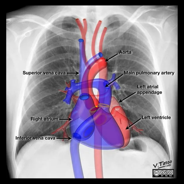 Cardiac Anatomy on PA Chest X-ray