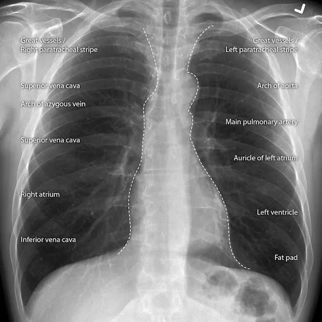 PA Chest X-ray: Cardiac & Great Vessel Landmarks