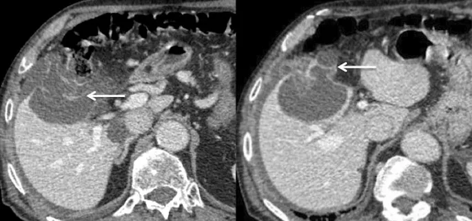 Axial CT abdomen: Hepatic lesion enhancement with contrast