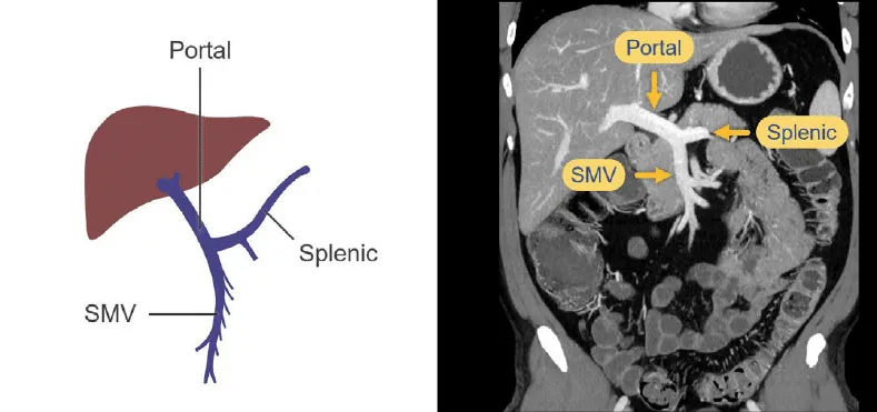 Portal venous anatomy: diagram vs. CT