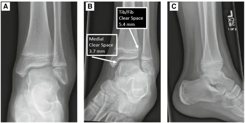 Ankle Mortise Radiographs with Measurements
