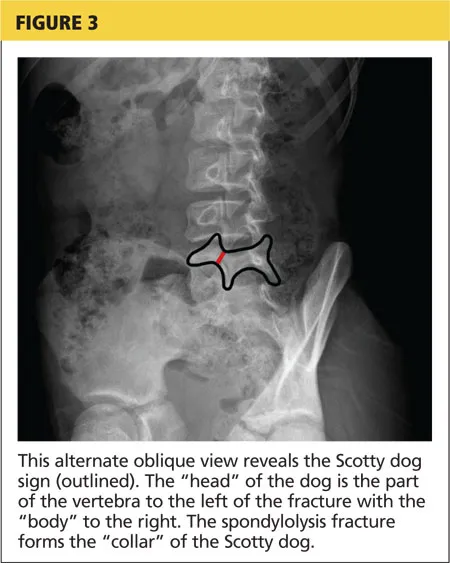 Oblique lumbar spine radiograph with Scotty dog sign