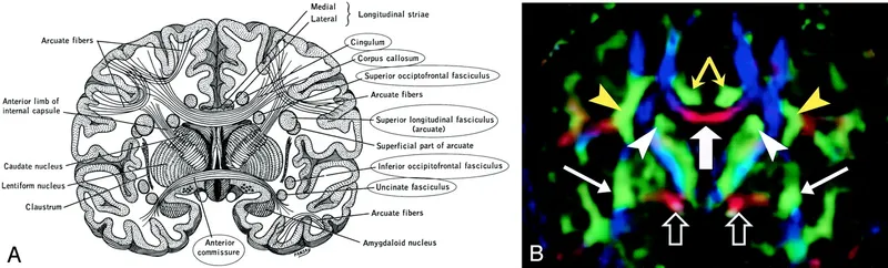Coronal brain view: white matter tracts & DTI