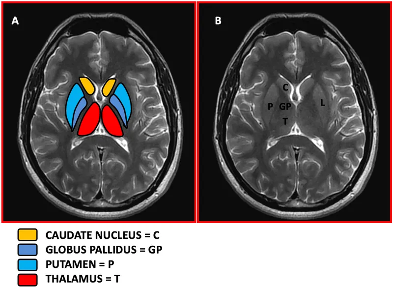 Axial T2 MRI brain: basal ganglia and thalamus