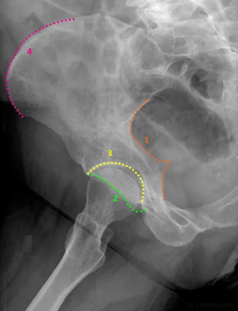 Pelvic radiograph with key anatomical landmarks highlighted